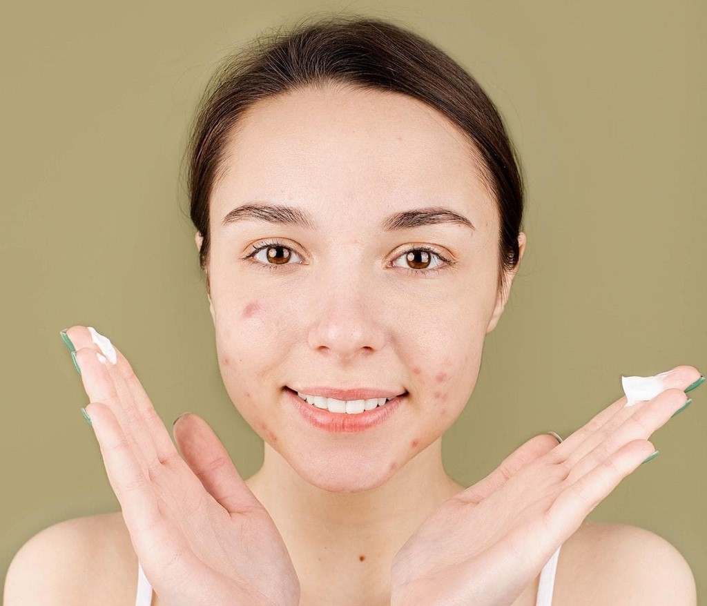 ¿Qué es el peeling químico y cuáles son sus beneficios?