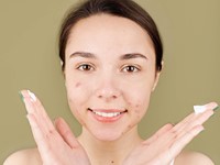 ¿Qué es el peeling químico y cuáles son sus beneficios?
